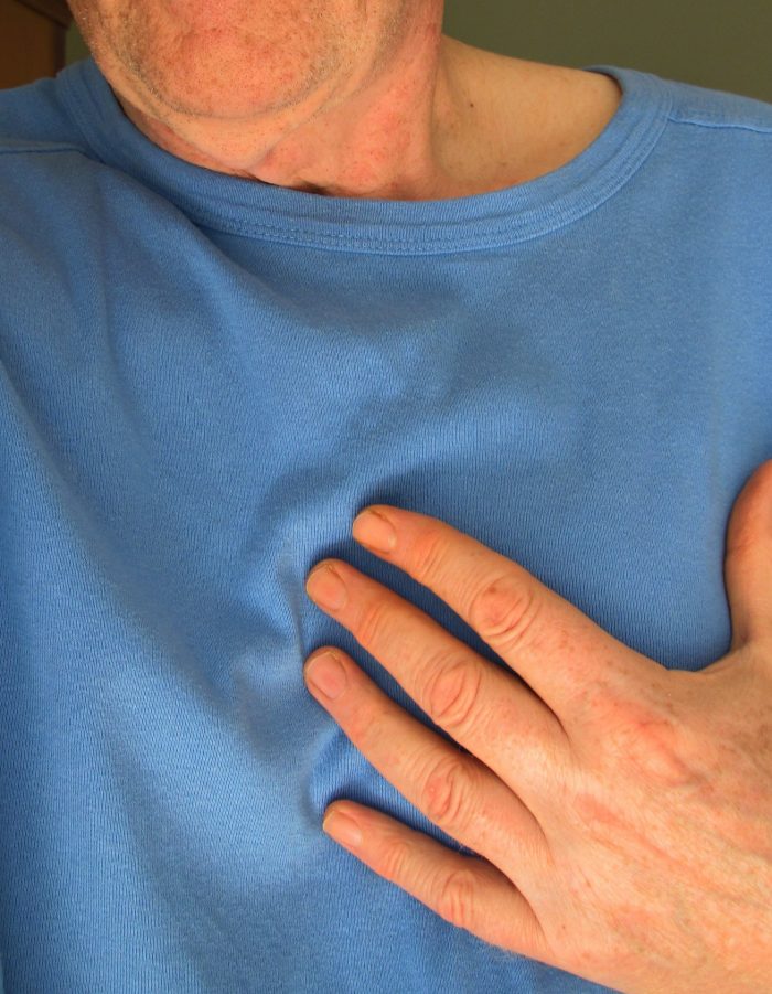 Infarto al miocardio