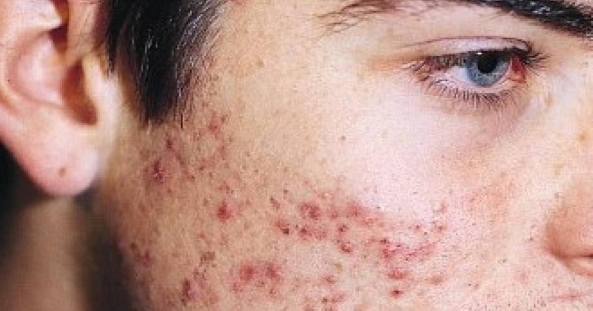 Acne-tratamientos-destacada