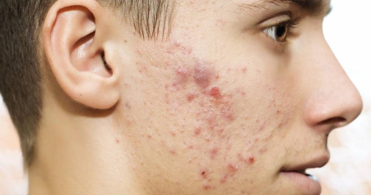 acne-tratamientos-causas