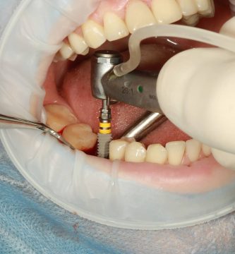 implantes dentales
